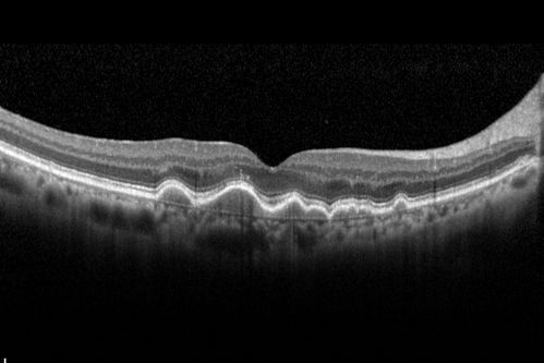 Polypoidal Choroidal Vasculopathy with Pulsating ICG polyp left eye
