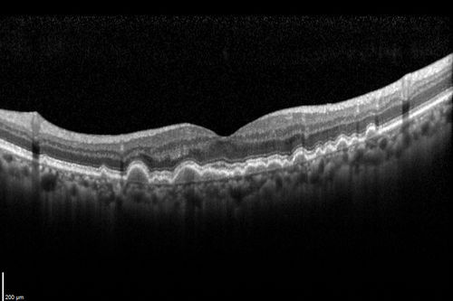Polypoidal Choroidal Vasculopathy with Pulsating ICG polyp left eye
