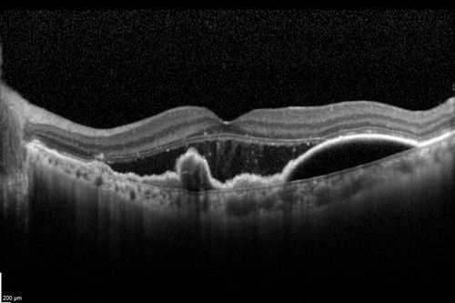 Polypoidal Choroidal Vasculopathy with Pulsating ICG polyp left eye
