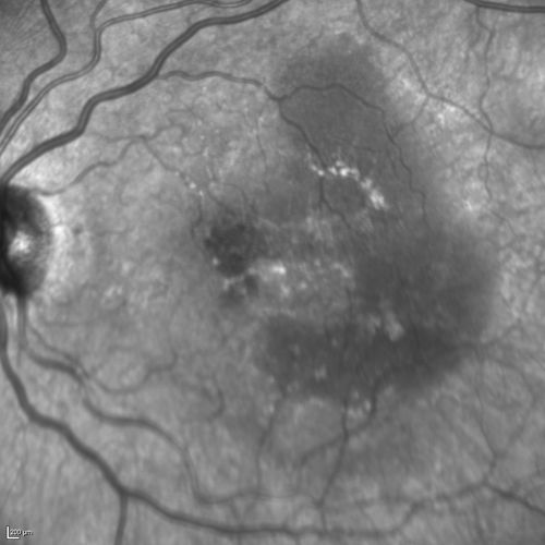 Polypoidal Choroidal Vasculopathy with Pulsating ICG polyp left eye
