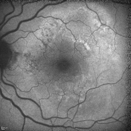 Polypoidal Choroidal Vasculopathy with Pulsating ICG polyp left eye
