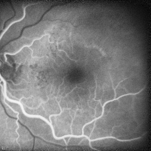Polypoidal Choroidal Vasculopathy with Pulsating ICG polyp left eye
