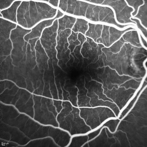 Polypoidal Choroidal Vasculopathy with Pulsating ICG polyp left eye
