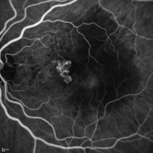 Polypoidal Choroidal Vasculopathy with Pulsating ICG polyp left eye
