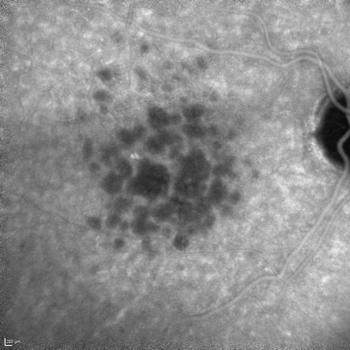 Polypoidal Choroidal Vasculopathy with Pulsating ICG polyp left eye

