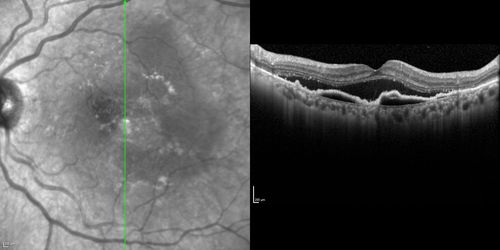 Polypoidal Choroidal Vasculopathy with Pulsating ICG polyp left eye
