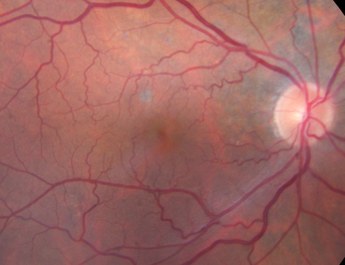 Polypoidal Choroidal Vasculopathy Left Eye
74 year old man with vision loss to 20/100 over a few months.  He improved to 20/20 with Lucentis.  The color and ICG show the polyps.
