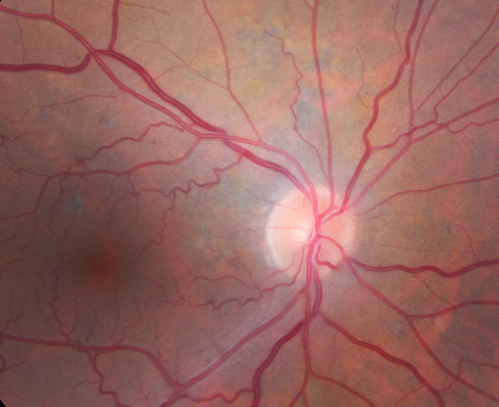 Polypoidal Choroidal Vasculopathy Left Eye
74 year old man with vision loss to 20/100 over a few months.  He improved to 20/20 with Lucentis.  The color and ICG show the polyps.
