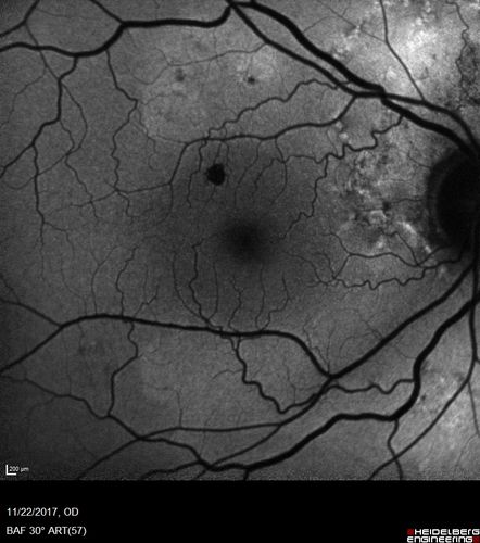 Polypoidal Choroidal Vasculopathy Left Eye
74 year old man with vision loss to 20/100 over a few months.  He improved to 20/20 with Lucentis.  The color and ICG show the polyps.
