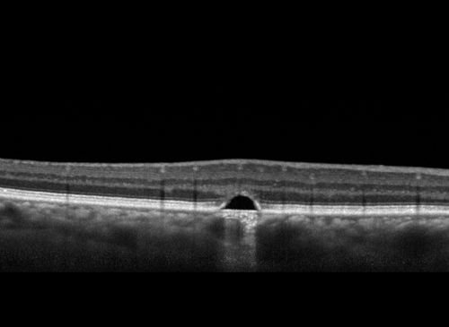 Polypoidal Choroidal Vasculopathy Left Eye
74 year old man with vision loss to 20/100 over a few months.  He improved to 20/20 with Lucentis.  The color and ICG show the polyps.
