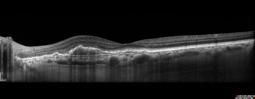 Polypoidal Choroidal Vasculopathy Left Eye
74 year old man with vision loss to 20/100 over a few months.  He improved to 20/20 with Lucentis.  The color and ICG show the polyps.
