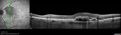Polypoidal Choroidal Vasculopathy Left Eye
74 year old man with vision loss to 20/100 over a few months.  He improved to 20/20 with Lucentis.  The color and ICG show the polyps.
