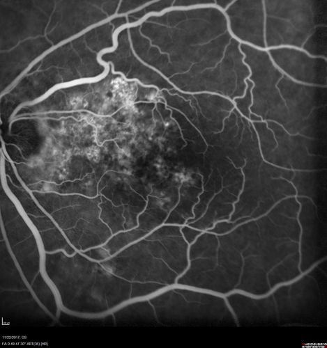 Polypoidal Choroidal Vasculopathy Left Eye
74 year old man with vision loss to 20/100 over a few months.  He improved to 20/20 with Lucentis.  The color and ICG show the polyps.
