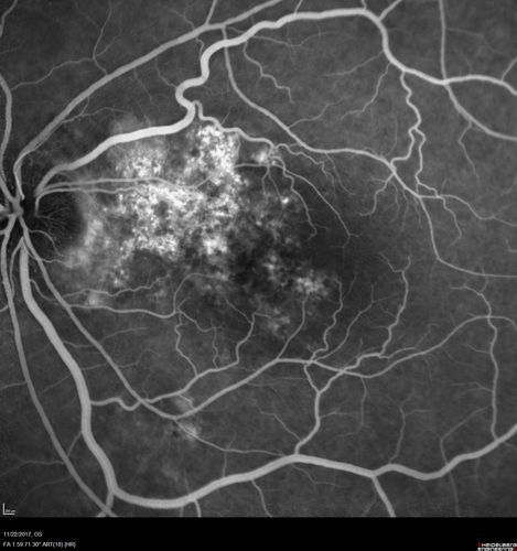 Polypoidal Choroidal Vasculopathy Left Eye
74 year old man with vision loss to 20/100 over a few months.  He improved to 20/20 with Lucentis.  The color and ICG show the polyps.
