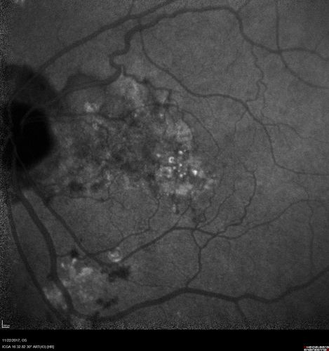 Polypoidal Choroidal Vasculopathy Left Eye
74 year old man with vision loss to 20/100 over a few months.  He improved to 20/20 with Lucentis.  The color and ICG show the polyps.
