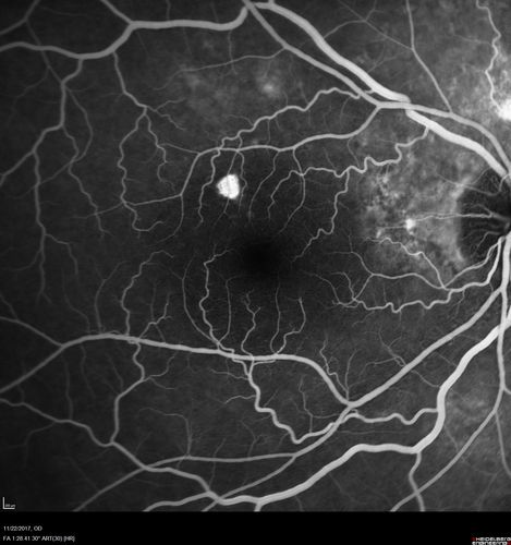 Polypoidal Choroidal Vasculopathy Left Eye
74 year old man with vision loss to 20/100 over a few months.  He improved to 20/20 with Lucentis.  The color and ICG show the polyps.
