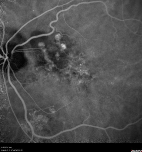 Polypoidal Choroidal Vasculopathy Left Eye
74 year old man with vision loss to 20/100 over a few months.  He improved to 20/20 with Lucentis.  The color and ICG show the polyps.
