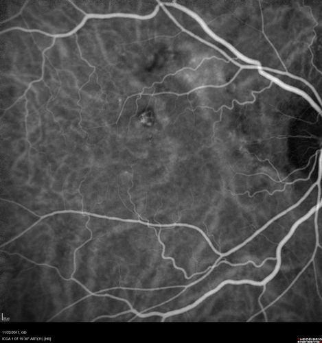 Polypoidal Choroidal Vasculopathy Left Eye
74 year old man with vision loss to 20/100 over a few months.  He improved to 20/20 with Lucentis.  The color and ICG show the polyps.
