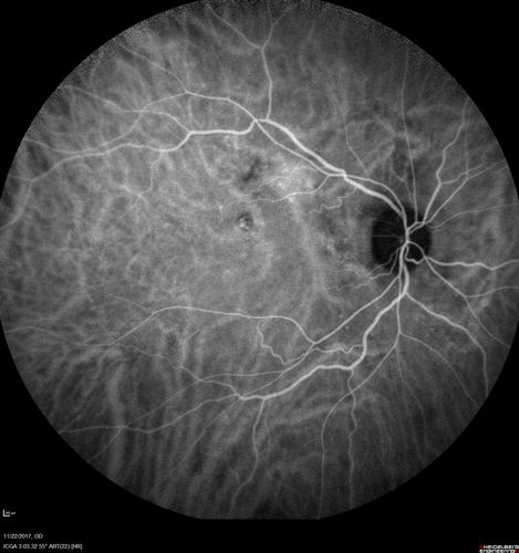 Polypoidal Choroidal Vasculopathy Left Eye
74 year old man with vision loss to 20/100 over a few months.  He improved to 20/20 with Lucentis.  The color and ICG show the polyps.
