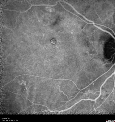 Polypoidal Choroidal Vasculopathy Left Eye
74 year old man with vision loss to 20/100 over a few months.  He improved to 20/20 with Lucentis.  The color and ICG show the polyps.
