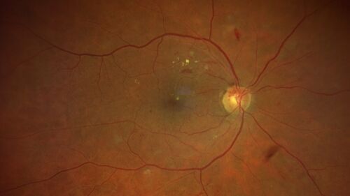 Prethreshold PDR right eye - mild NVD
