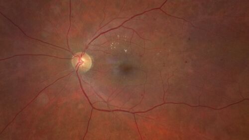 Prethreshold PDR right eye - mild NVD
