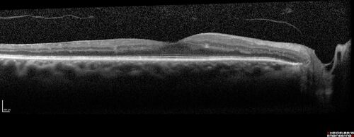 Prethreshold PDR right eye - mild NVD
