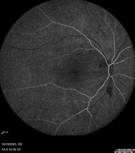 Prethreshold PDR right eye - mild NVD

