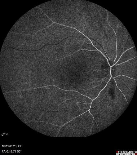 Prethreshold PDR right eye - mild NVD
