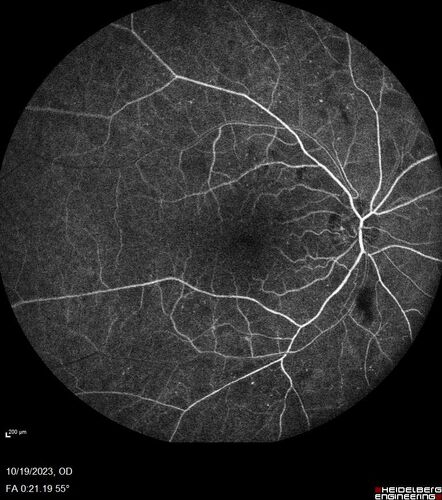 Prethreshold PDR right eye - mild NVD
