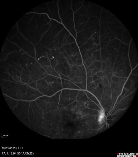 Prethreshold PDR right eye - mild NVD
