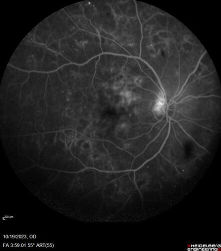 Prethreshold PDR right eye - mild NVD
