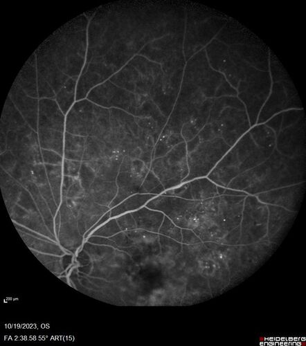 Prethreshold PDR right eye - mild NVD
