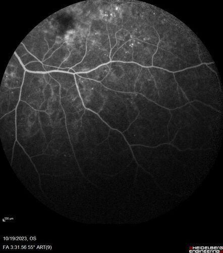 Prethreshold PDR right eye - mild NVD
