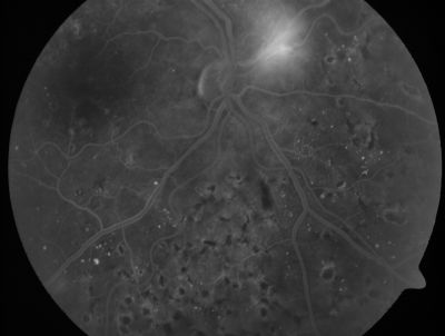 PDR - Mild Vitreous Hemorrhage and Good Vision
58-year-old woman has diabetic retinopathy in both eyes with neovascularization of the optic nerve, worse in the right eye than the left eye.  She has had panretinal laser in both eyes and vitreous hemorrhage in the left eye.  Her vision, since I saw her last in June, is about the same.  

VISUAL ACUITY:  Vision OD is 20/25, OS is 20/20. 
