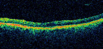 PDR
58-year-old woman has diabetic retinopathy in both eyes with neovascularization of the optic nerve, worse in the right eye than the left eye.  She has had panretinal laser in both eyes and vitreous hemorrhage in the left eye.  Her vision, since I saw her last in June, is about the same.  

VISUAL ACUITY:  Vision OD is 20/25, OS is 20/20. 
