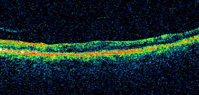 PDR - Macula Line Scan
58-year-old woman has diabetic retinopathy in both eyes with neovascularization of the optic nerve, worse in the right eye than the left eye.  She has had panretinal laser in both eyes and vitreous hemorrhage in the left eye.  Her vision, since I saw her last in June, is about the same.  

VISUAL ACUITY:  Vision OD is 20/25, OS is 20/20. 
