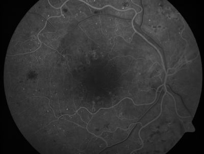 PDR - Mild Vitreous Hemorrhage and Good Vision
58-year-old woman has diabetic retinopathy in both eyes with neovascularization of the optic nerve, worse in the right eye than the left eye.  She has had panretinal laser in both eyes and vitreous hemorrhage in the left eye.  Her vision, since I saw her last in June, is about the same.  

VISUAL ACUITY:  Vision OD is 20/25, OS is 20/20. 
