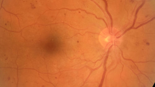 Moderate PDR
43 year old man 20/32 vision in both eyes.  Being started on Anti-VEGF injections which will be followed by PRP.
