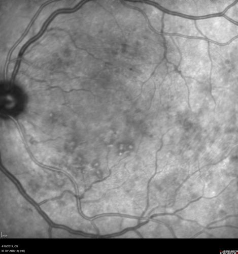 Moderate PDR
43 year old man 20/32 vision in both eyes.  Being started on Anti-VEGF injections which will be followed by PRP.
