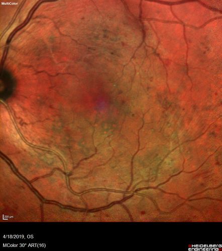 Moderate PDR
43 year old man 20/32 vision in both eyes.  Being started on Anti-VEGF injections which will be followed by PRP.
