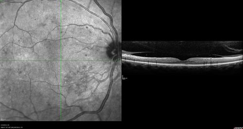 Moderate PDR
43 year old man 20/32 vision in both eyes.  Being started on Anti-VEGF injections which will be followed by PRP.
