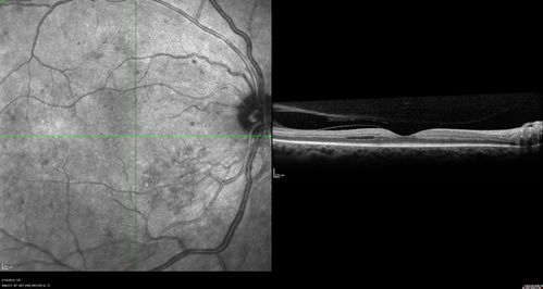 Moderate PDR
43 year old man 20/32 vision in both eyes.  Being started on Anti-VEGF injections which will be followed by PRP.
