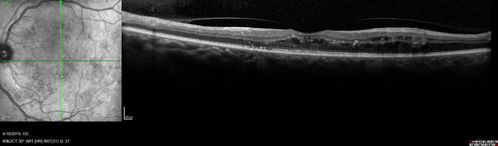 Moderate PDR
43 year old man 20/32 vision in both eyes.  Being started on Anti-VEGF injections which will be followed by PRP.
