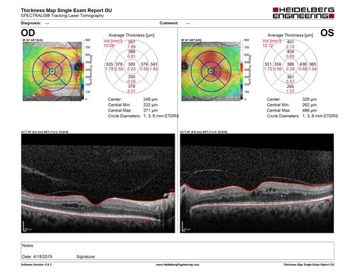 Moderate PDR
43 year old man 20/32 vision in both eyes.  Being started on Anti-VEGF injections which will be followed by PRP.
