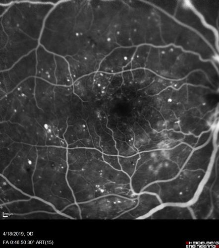 Moderate PDR
43 year old man 20/32 vision in both eyes.  Being started on Anti-VEGF injections which will be followed by PRP.
