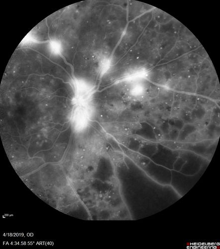 Moderate PDR
43 year old man 20/32 vision in both eyes.  Being started on Anti-VEGF injections which will be followed by PRP.
