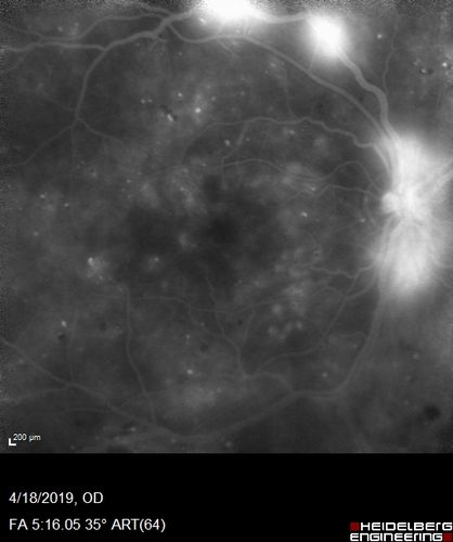 Moderate PDR
43 year old man 20/32 vision in both eyes.  Being started on Anti-VEGF injections which will be followed by PRP.

