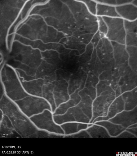 Moderate PDR
43 year old man 20/32 vision in both eyes.  Being started on Anti-VEGF injections which will be followed by PRP.
