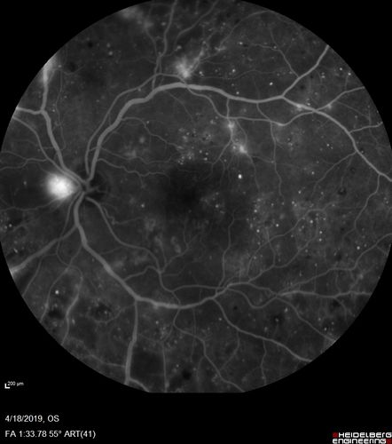 Moderate PDR
43 year old man 20/32 vision in both eyes.  Being started on Anti-VEGF injections which will be followed by PRP.

